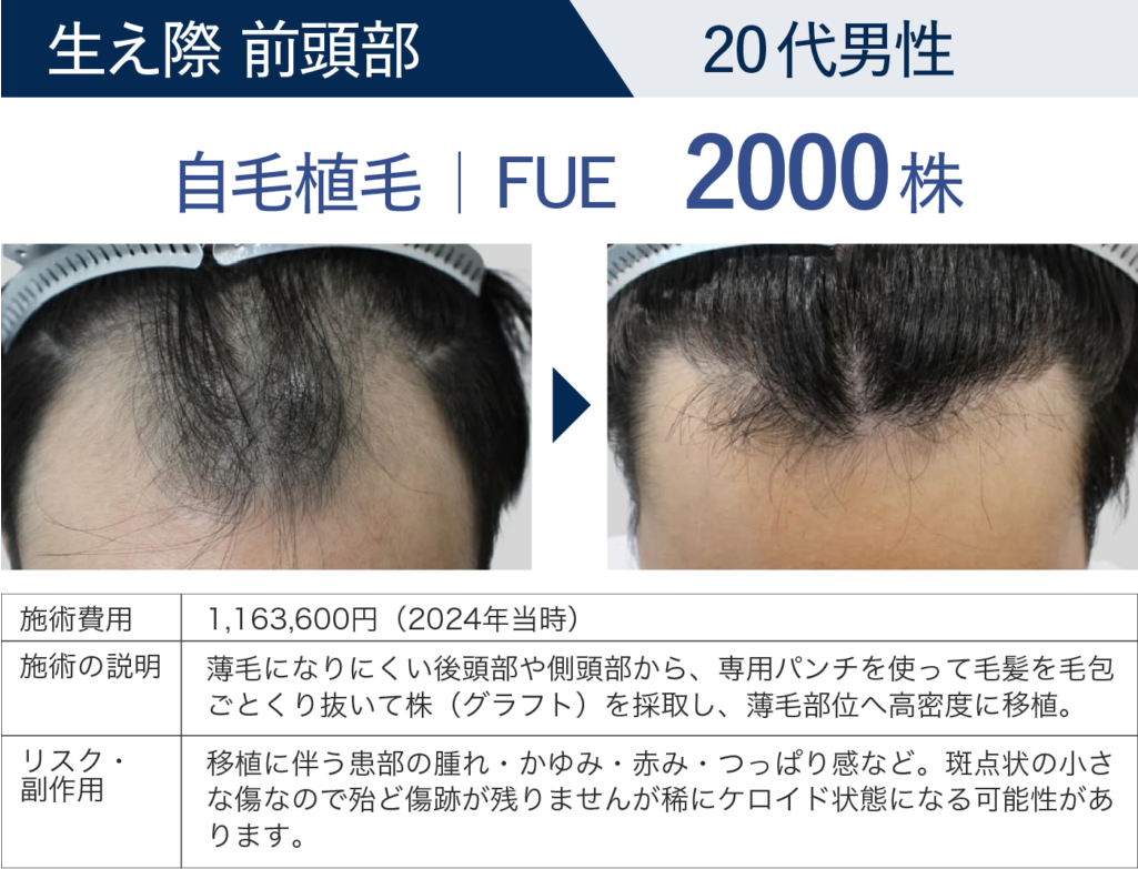 生え際 前頭部 20代男性 自毛植毛 FUE 2000株の症例詳細