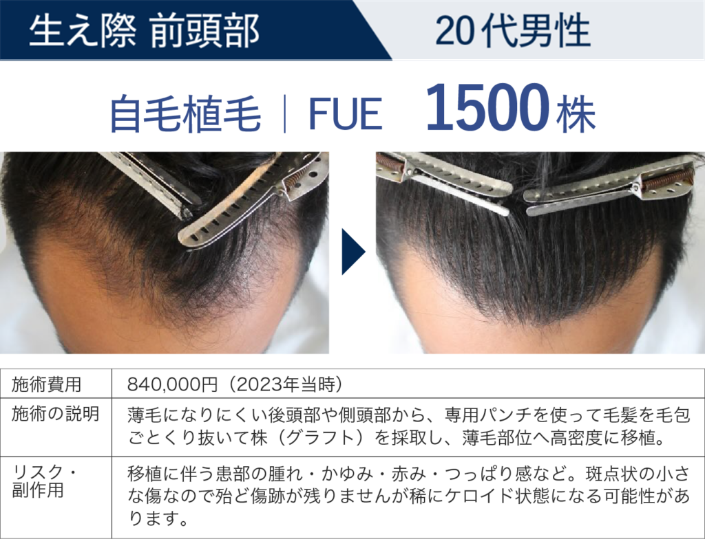 生え際 前頭部 20代男性 自毛植毛 FUE 1500株の症例詳細
