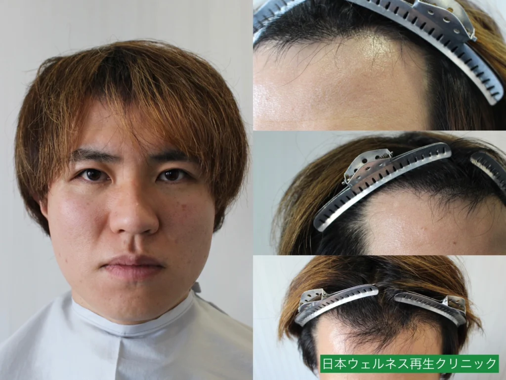 H・Iさんのオペ6ヶ月後