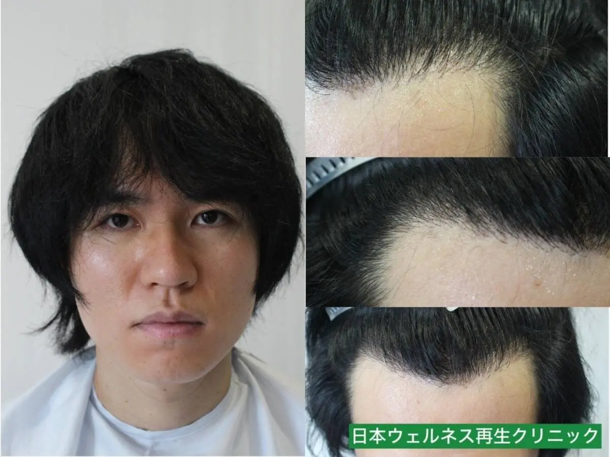 D・Kさん 30代男性 FUE 1100株の症例写真