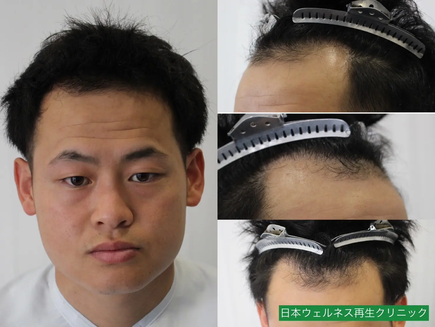M・Tさん 20代男性 FUT 1200株の症例写真