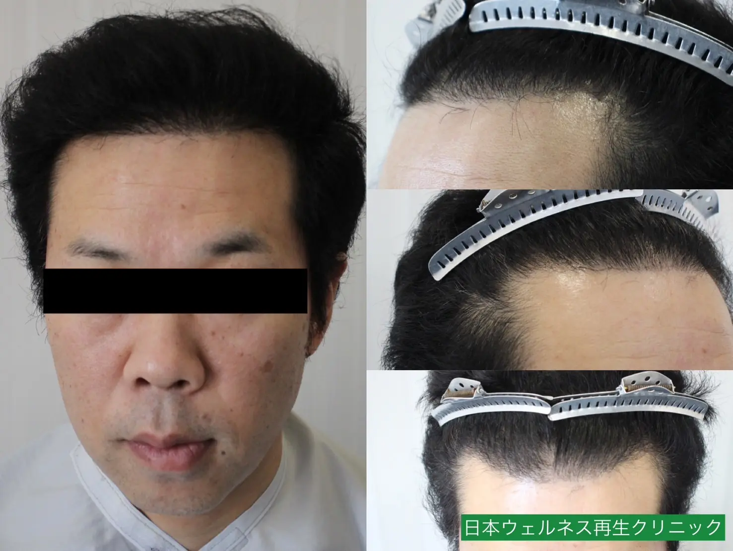 T・Oさん 40代男性 FUT 1300株の症例写真