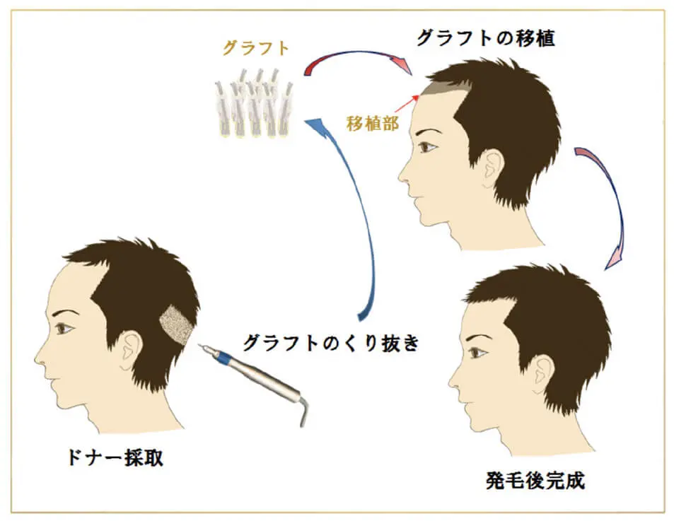 FUE法の図解