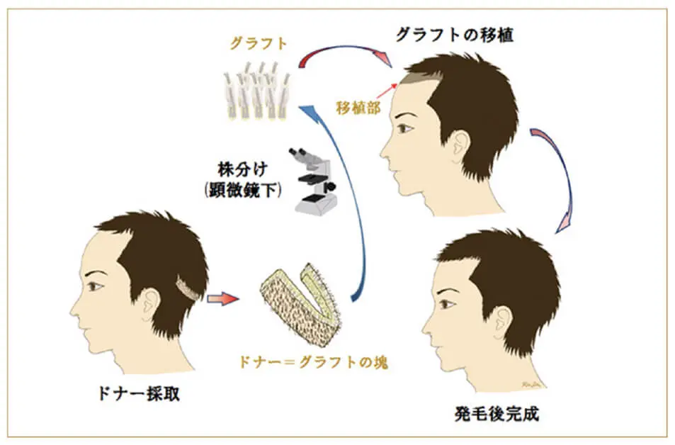 山本式FUT法の図解