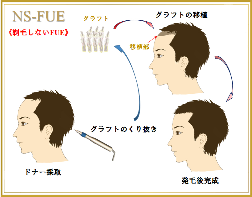NS-FUE法で剃毛せずにグラフトを採取して移植する流れの図解
